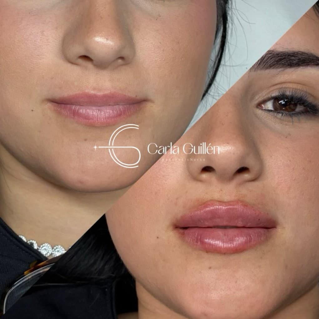Aumento de labios — Carla Guillén, Gran Canaria